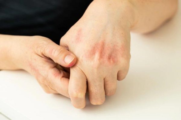 财聚配资 震惊！孩子患湿疹，不能穿衣服？胡说八道